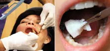 Gaze Dental Hemostática