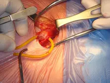 Drapeado de la incisión quirúrgica