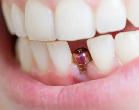 Zirconium Crowns